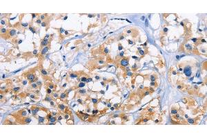 Immunohistochemistry of paraffin-embedded Human thyroid cancer tissue using CAPZA3 Polyclonal Antibody at dilution 1:70 (CAPZA3 抗体)