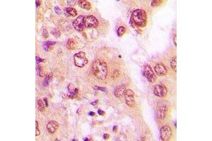 Immunohistochemical analysis of PSMA6 staining in human lung cancer formalin fixed paraffin embedded tissue section. (PSMA6 抗体)