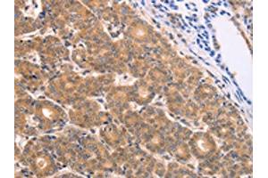 The image on the left is immunohistochemistry of paraffin-embedded Human thyroid cancer tissue using ABIN7128689(BTG3 Antibody) at dilution 1/15, on the right is treated with fusion protein. (BTG3 抗体)
