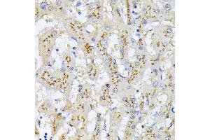 Immunohistochemistry of paraffin-embedded human colon carcinoma using GOLPH2 Rabbit pAb  at dilution of 1:100 (40x lens). (GOLM1 抗体)