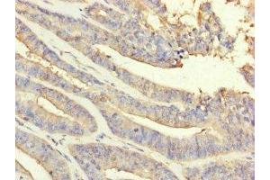 Immunohistochemistry of paraffin-embedded human endometrial cancer using ABIN7162936 at dilution of 1:100 (Peroxiredoxin 2 抗体  (AA 2-65))