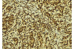 ABIN6274223 at 1/100 staining Human breast cancer tissue by IHC-P.