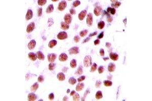 Immunohistochemical analysis of DIDO1 staining in human breast cancer formalin fixed paraffin embedded tissue section. (DIDO1 抗体  (N-Term))
