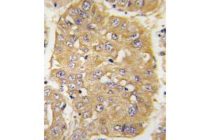 Formalin-fixed and paraffin-embedded human hepatocarcinoma tissue reacted with IGFBP3 Antibody , which was peroxidase-conjugated to the secondary antibody, followed by DAB staining.