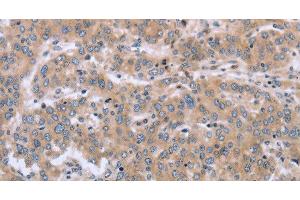 Immunohistochemistry of paraffin-embedded Human liver cancer using MAPRE3 Polyclonal Antibody at dilution of 1:30 (ECE1 抗体)