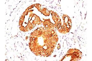 Formalin-fixed, paraffin-embedded human Breast Carcinoma stained with MUC-1 Mouse Monoclonal Antibody (MUC1/845). (MUC1 抗体)