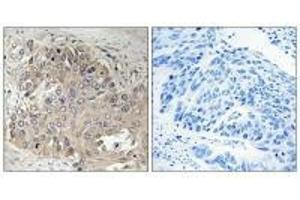 Immunohistochemistry analysis of paraffin-embedded human lung carcinoma tissue using SPTBN5 antibody. (SPTbN5 抗体)