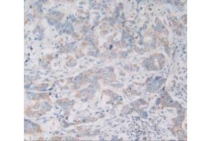 Detection of VNN1 in Human Breast Cancer Tissue using Polyclonal Antibody to Vanin 1 (VNN1) (VNN1 抗体  (AA 36-223))