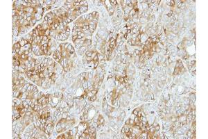 IHC-P Image Immunohistochemical analysis of paraffin-embedded SW480 xenograft, using PFKL, antibody at 1:500 dilution. (PFKL 抗体  (Center))