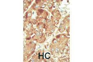 Formalin-fixed and paraffin-embedded human hepatocellular carcinoma tissue reacted with NLK polyclonal antibody  , which was peroxidase-conjugated to the secondary antibody, followed by DAB staining. (Nemo-Like Kinase 抗体  (C-Term))