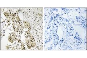 Immunohistochemistry analysis of paraffin-embedded human breast carcinoma, using TAGAP Antibody. (TAGAP 抗体  (AA 191-240))