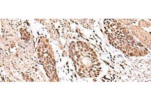 Immunohistochemistry of paraffin-embedded Human esophagus cancer tissue using ACTL6B Polyclonal Antibody at dilution of 1:100(x200) (Actin-Like 6B 抗体)