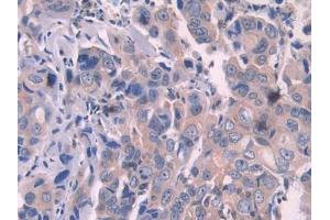 Used in DAB staining on fromalin fixed paraffin- embedded stomach cancer tissue (OAS1 抗体  (AA 74-165))