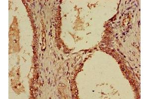 Immunohistochemistry of paraffin-embedded human prostate cancer using ABIN7156122 at dilution of 1:100 (KPNA4 抗体  (AA 51-239))