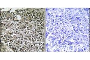 Immunohistochemistry analysis of paraffin-embedded human breast carcinoma tissue, using NFAT3 (Ab-676) Antibody.