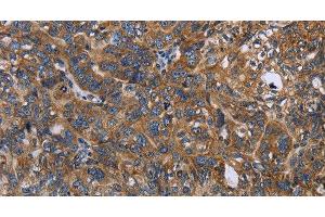 Immunohistochemistry of paraffin-embedded Human ovarian cancer tissue using LGALS2 Polyclonal Antibody at dilution 1:30 (Galectin 2 抗体)
