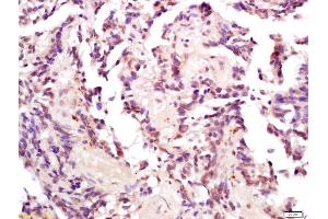 Formalin-fixed and paraffin embedded human gastric carcinoma labeled with Anti-Phospho-MDM2(Thr218) Polyclonal Antibody, Unconjugated (ABIN802533) at 1:200 followed by conjugation to the secondary antibody and DAB staining (MDM2 抗体  (pThr218))