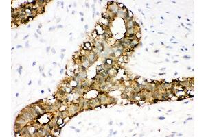Anti- Annexin A3 Picoband antibody, IHC(P) IHC(P): Human Mammary Cancer Tissue (Annexin A3 抗体  (Middle Region))