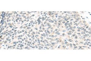 Immunohistochemistry of paraffin-embedded Human lung cancer tissue using ELOC Polyclonal Antibody at dilution 1:40