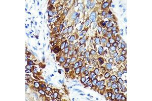Immunohistochemistry of paraffin-embedded human lung cancer using Cathepsin B Rabbit mAb (ABIN7266148) at dilution of 1:100 (40x lens). (Cathepsin B 抗体)
