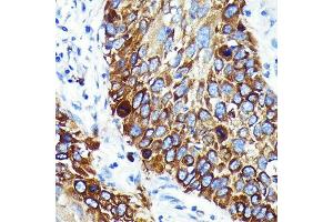 Immunohistochemistry of paraffin-embedded human lung cancer using Cathepsin B Rabbit mAb (ABIN7266148) at dilution of 1:100 (40x lens). (Cathepsin B 抗体)