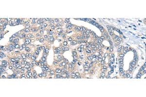 Immunohistochemistry of paraffin-embedded Human liver cancer tissue using AURKA Polyclonal Antibody at dilution of 1:40(x200) (Aurora A 抗体)