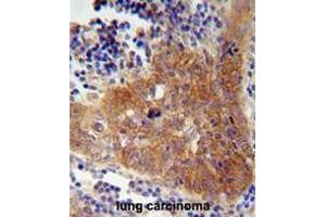FBXW8 Antibody (Center) immunohistochemistry analysis in formalin fixed and paraffin embedded human lung carcinoma followed by peroxidase conjugation of the secondary antibody and DAB staining.