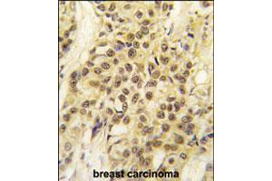 Formalin-fixed and paraffin-embedded human breast carcinoma tissue reacted with MYST1 polyclonal antibody  , which was peroxidase-conjugated to the secondary antibody, followed by DAB staining. (MYST1 抗体  (AA 417-446))