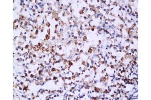 Formalin-fixed and paraffin embedded: human endometrium carcinoma labeled with Anti-Caspase-6 Polyclonal Antibody , Unconjugated 1:200 followed by conjugation to the secondary antibody and DAB staining (Caspase 6 抗体  (AA 151-250))
