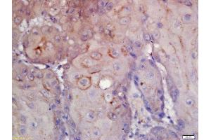 Formalin-fixed and paraffin embedded human laryngeal carcinoma labeled with Rabbit Anti-CD276/B7H3 Polyclonal Antibody, Unconjugated (ABIN1385603) at 1:200 followed by conjugation to the secondary antibody and DAB staining (CD276 抗体  (AA 101-200))