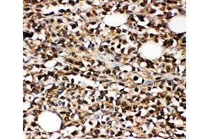 IHC-P: CD10 antibody testing of human B-lymphocyte cancer tissue (MME 抗体  (AA 52-750))