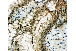 IHC-P: HSP70 antibody testing of human intestinal cancer tissue (HSP70 抗体  (AA 577-596))