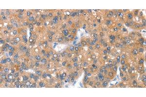 Immunohistochemistry of paraffin-embedded Human liver cancer tissue using CD238 Polyclonal Antibody at dilution 1:40 (KEL 抗体)