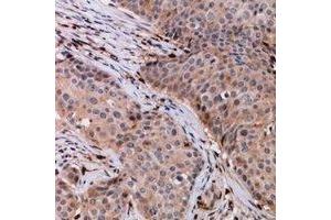 Immunohistochemical analysis of VPS54 staining in human breast cancer formalin fixed paraffin embedded tissue section. (VPS54 抗体)