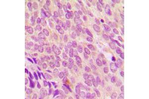 Immunohistochemical analysis of SDCCAG8 staining in human breast cancer formalin fixed paraffin embedded tissue section. (SDCCAG8 抗体  (C-Term))