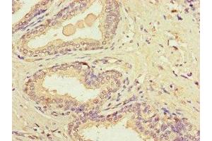 Immunohistochemistry of paraffin-embedded human prostate cancer using ABIN7149154 at dilution of 1:100 (COX1 抗体  (AA 474-513))