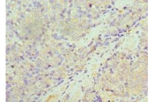 Immunohistochemistry of paraffin-embedded human colon cancer using ABIN7170948 at dilution of 1:100