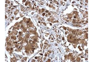 IHC-P Image EPS8 antibody [C3], C-term detects EPS8 protein at cytosol and nucleus on human breast carcinoma by immunohistochemical analysis. (EPS8 抗体  (C-Term))