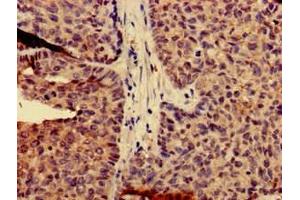 Immunohistochemistry of paraffin-embedded human ovarian cancer using ABIN7146536 at dilution of 1:100 (Calpain 14 抗体  (AA 68-366))