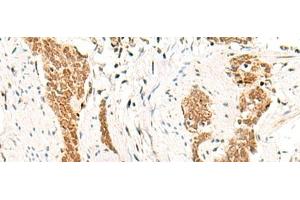 Immunohistochemistry of paraffin-embedded Human esophagus cancer tissue using HOXC13 Polyclonal Antibody at dilution of 1:60(x200) (HOXC13 抗体)