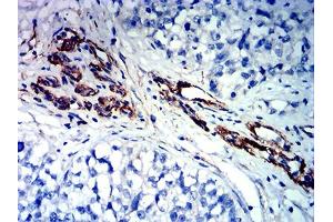 Immunohistochemical analysis of paraffin-embedded bladder cancer tissues using FLI1 mouse mAb with DAB staining. (FLI1 抗体  (AA 303-452))