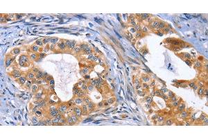 Immunohistochemistry of paraffin-embedded Human cervical cancer using MUSK Polyclonal Antibody at dilution of 1:30 (MUSK 抗体)