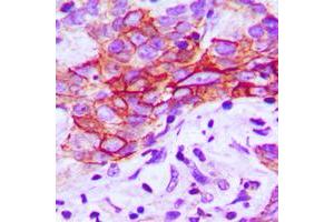 Immunohistochemical analysis of CMKLR1 staining in human breast cancer formalin fixed paraffin embedded tissue section. (CMKLR1 抗体  (Center))