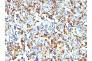 Formalin-fixed, paraffin-embedded human Histiocytoma stained with Factor XIIIa Mouse Monoclonal Antibody (F13A1/1683). (F13A1 抗体  (AA 46-181))