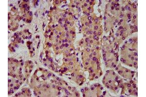 IHC image of ABIN7145642 diluted at 1:200 and staining in paraffin-embedded human pancreatic cancer performed on a Leica BondTM system. (BMPER 抗体  (AA 271-418))