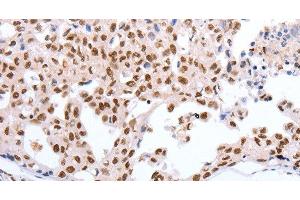 Immunohistochemistry of paraffin-embedded Human lung cancer tissue using Oct-6 Polyclonal Antibody at dilution 1:40 (POU3F1 抗体)