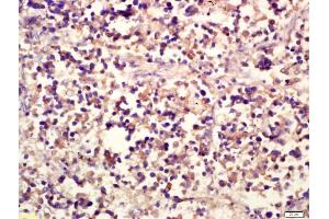 Formalin-fixed and paraffin embedded human lung carcinoma labeled with Anti-NCR3 Polyclonal Antibody, Unconjugated (ABIN739980) at 1:200 followed by conjugation to the secondary antibody and DAB staining (NCR3 抗体  (AA 81-180))