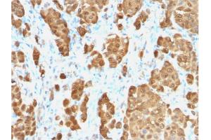Formalin-fixed, paraffin-embedded human Melanoma stained with S100B-Monospecific Recombinant Rabbit Monoclonal Antibody (S100B/1706R). (Recombinant S100B 抗体)