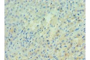 Immunohistochemistry of paraffin-embedded human liver cancer using ABIN7143277 at dilution of 1:100 (APRT 抗体  (AA 1-180))