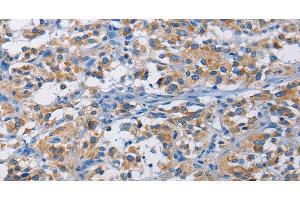 Immunohistochemistry of paraffin-embedded Human thyroid cancer tissue using RICTOR Polyclonal Antibody at dilution 1:50 (RICTOR 抗体)